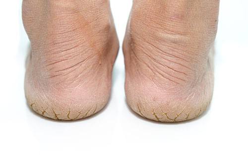 How to Stop Cracked Heels - ShoeInsoles 