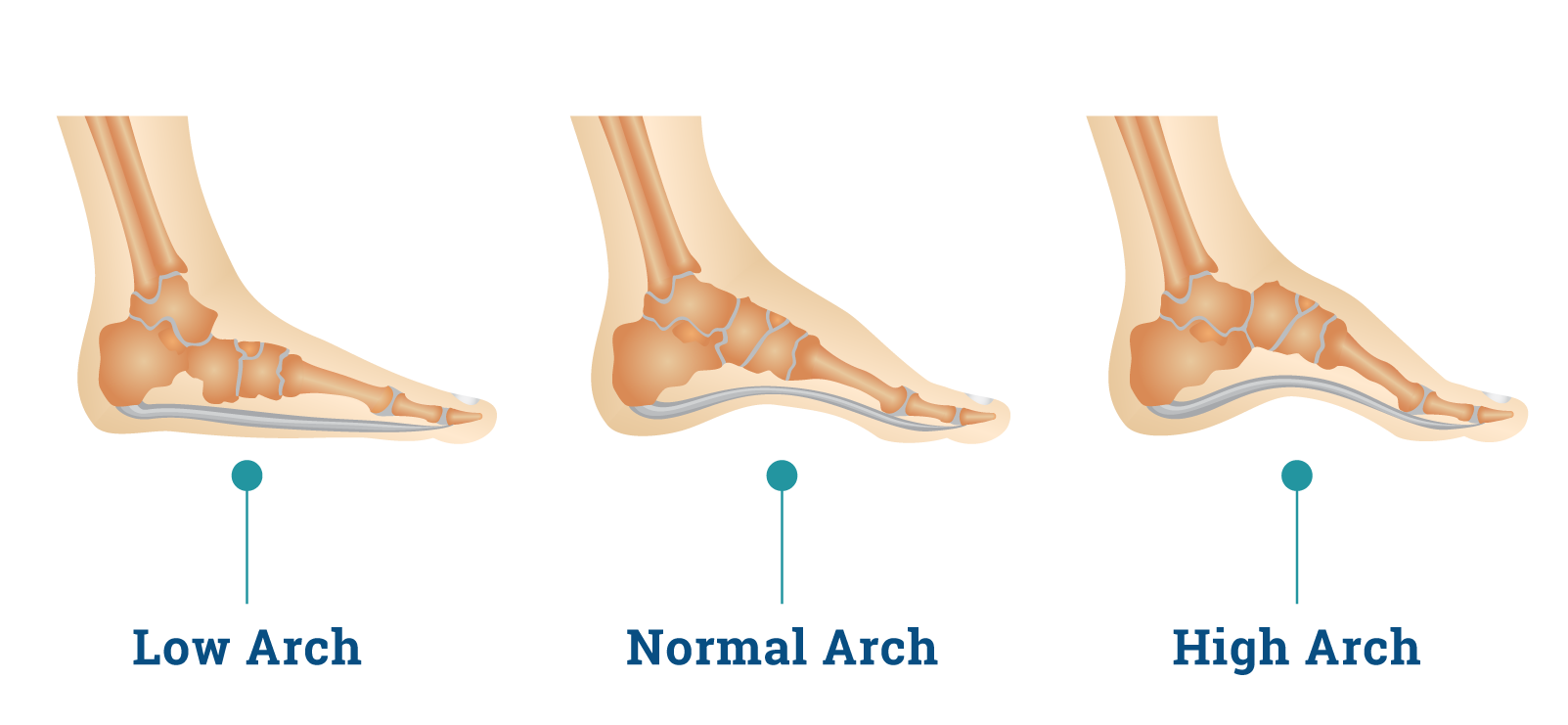 flat feet arch pain