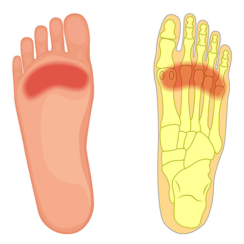 morton's foot insoles