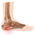 What is Plantar Fasciitis?