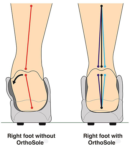 insoles to correct pronation