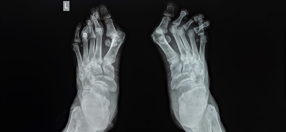 Pedag: Treating Bunions Without Surgery