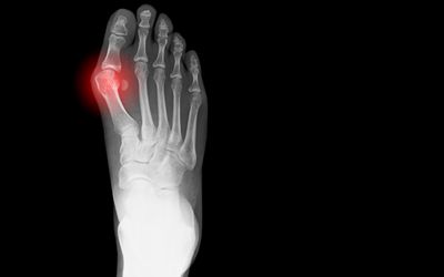 Bunion Pain Image